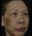 Fraxel FaceTreatment Gallery 5